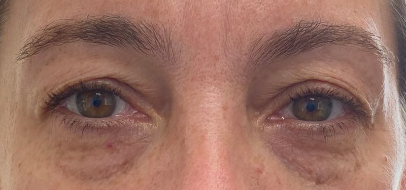 Blepharoplasty Before & After Gallery - Patient 87168892 - Image 1