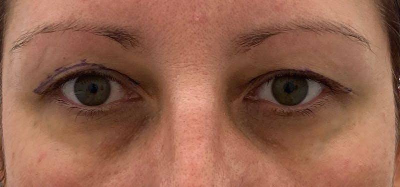 Blepharoplasty Before & After Gallery - Patient 87168893 - Image 1