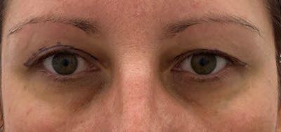 Blepharoplasty Before & After Gallery - Patient 87168893 - Image 1