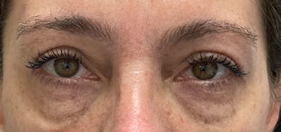 Blepharoplasty Before & After Gallery - Patient 87168892 - Image 2