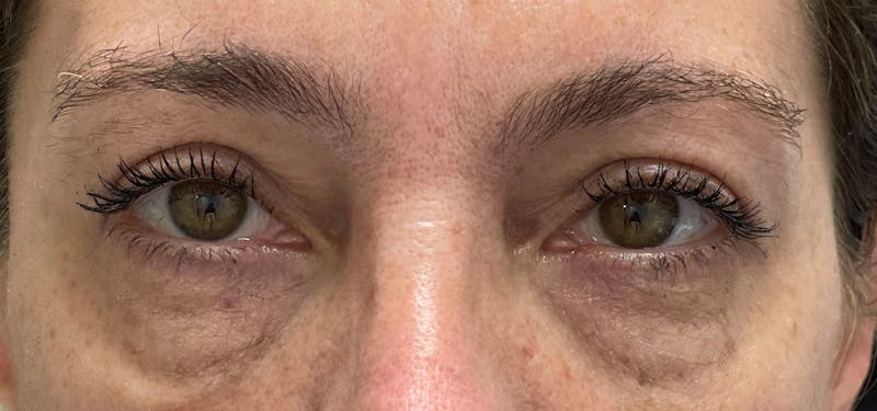 Blepharoplasty in Upper East Side patient 1