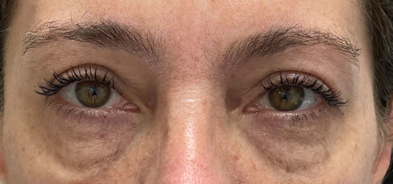 Blepharoplasty Before & After Gallery - Patient 87168892 - Image 2