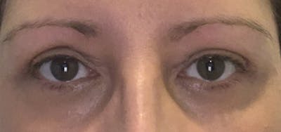 Blepharoplasty Before & After Gallery - Patient 87168893 - Image 2