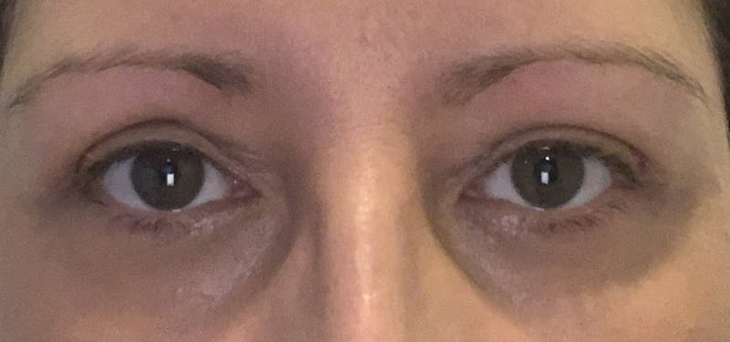 Blepharoplasty Before & After Gallery - Patient 87168893 - Image 2