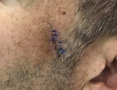 Scar Revision Before & After Gallery - Patient 87168883 - Image 1