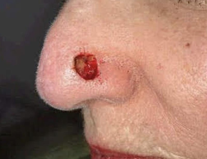 Skin Cancer Reconstruction Gallery - Patient 91459441 - Image 1
