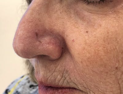 Skin Cancer Reconstruction Before & After Gallery - Patient 91459441 - Image 2