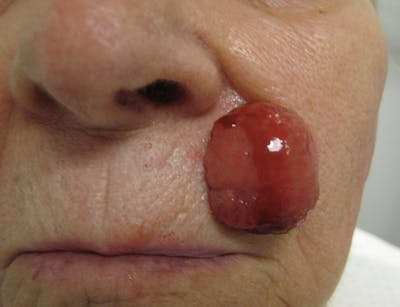 Skin Cancer Reconstruction Gallery - Patient 91459478 - Image 1