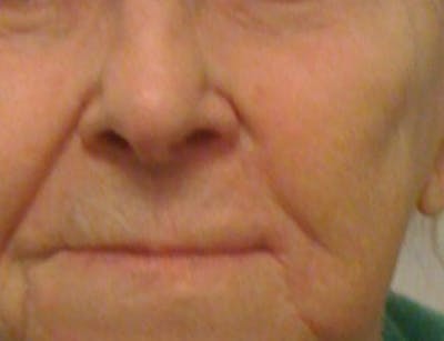Skin Cancer Reconstruction Before & After Gallery - Patient 91459478 - Image 2