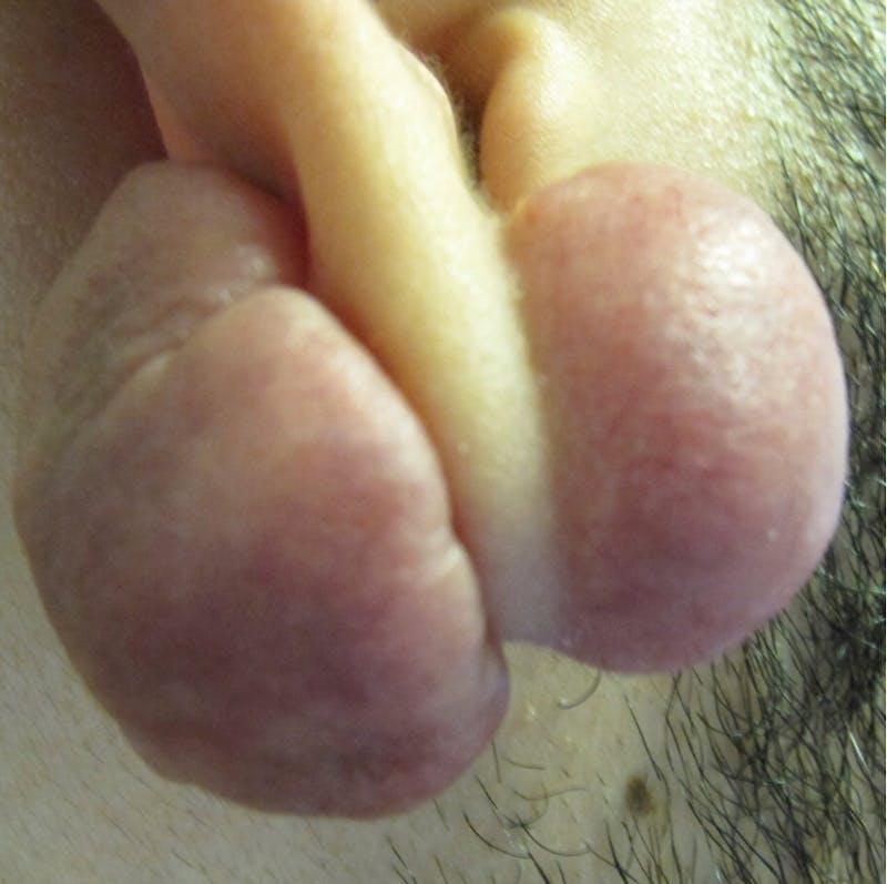 Keloid Removal Gallery - Patient 90379453 - Image 1