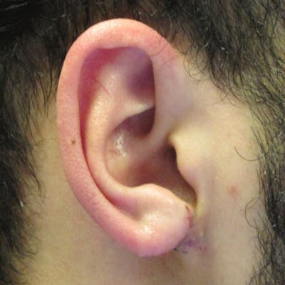 Keloid Removal Gallery - Patient 90379453 - Image 2