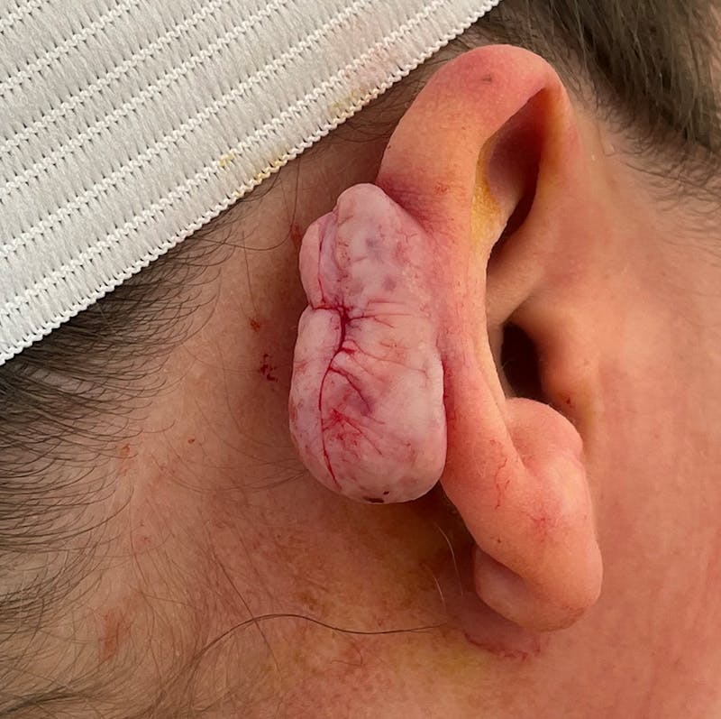 Keloid Removal Gallery - Patient 90379452 - Image 1