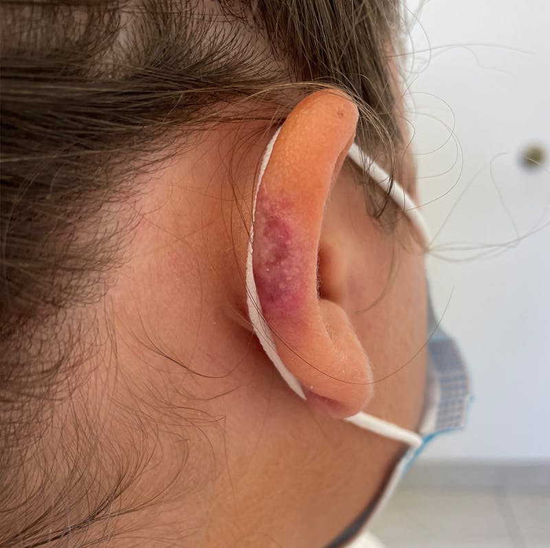 Keloid Removal Gallery - Patient 90379452 - Image 2