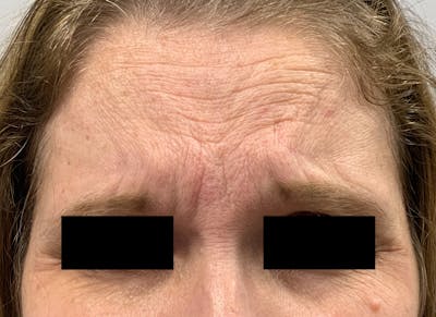 BOTOX Before & After Gallery - Patient 87168896 - Image 1