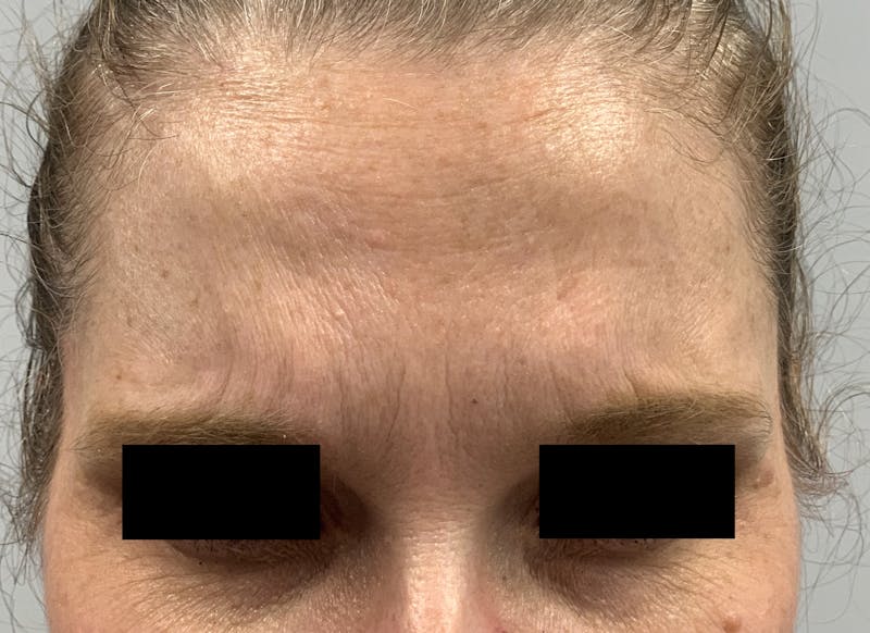 BOTOX Before & After Gallery - Patient 87168896 - Image 2