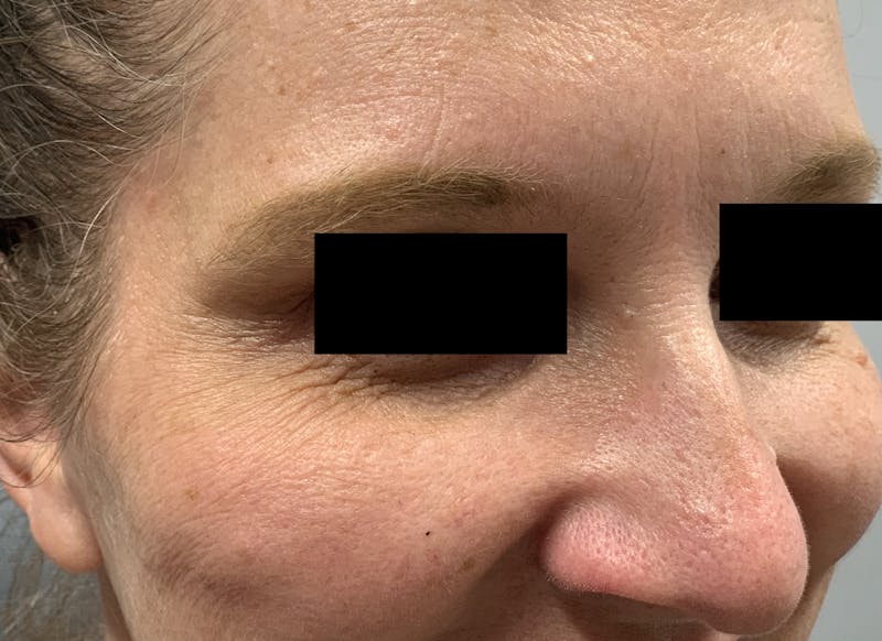 BOTOX Before & After Gallery - Patient 87168896 - Image 4
