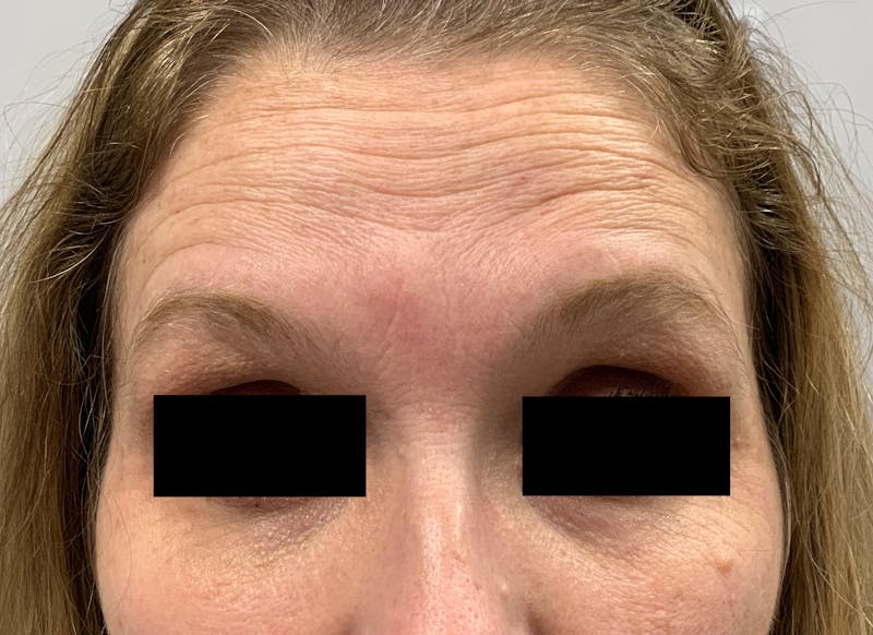 BOTOX Before & After Gallery - Patient 87168896 - Image 5