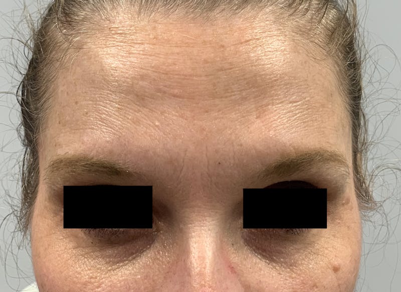 BOTOX Before & After Gallery - Patient 87168896 - Image 6