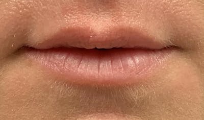 Lip Augmentation Before & After Gallery - Patient 87168913 - Image 1