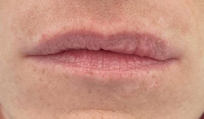 Lip Augmentation Before & After Gallery - Patient 87168914 - Image 1
