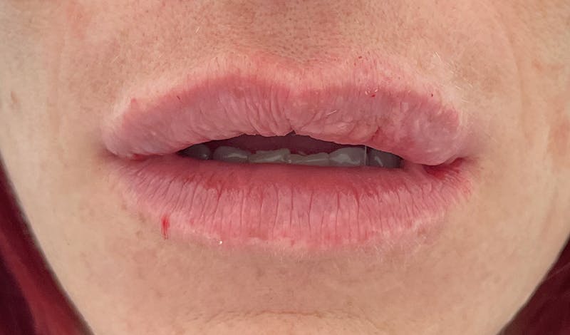 Lip Augmentation Before & After Gallery - Patient 87168914 - Image 2