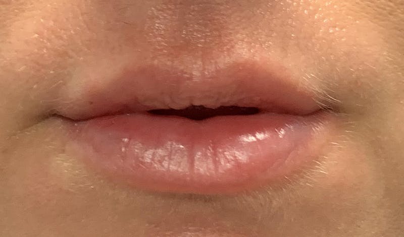 Lip Augmentation Before & After Gallery - Patient 87168913 - Image 2
