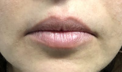 Lip Augmentation Before & After Gallery - Patient 87168915 - Image 1