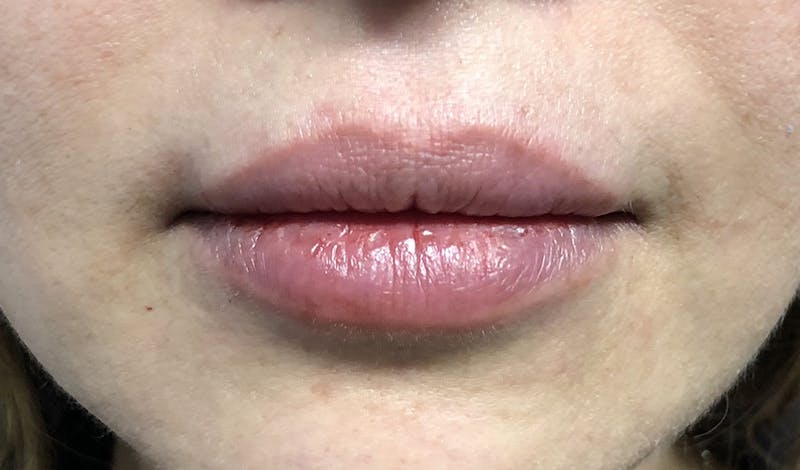 Lip Augmentation Before & After Gallery - Patient 87168915 - Image 2