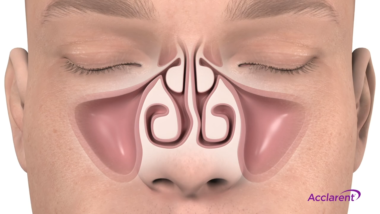 Cutaway view of sinuses