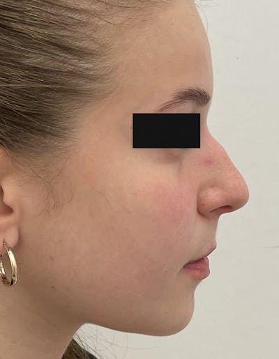 Rhinoplasty Before & After Gallery - Patient 93490328 - Image 1