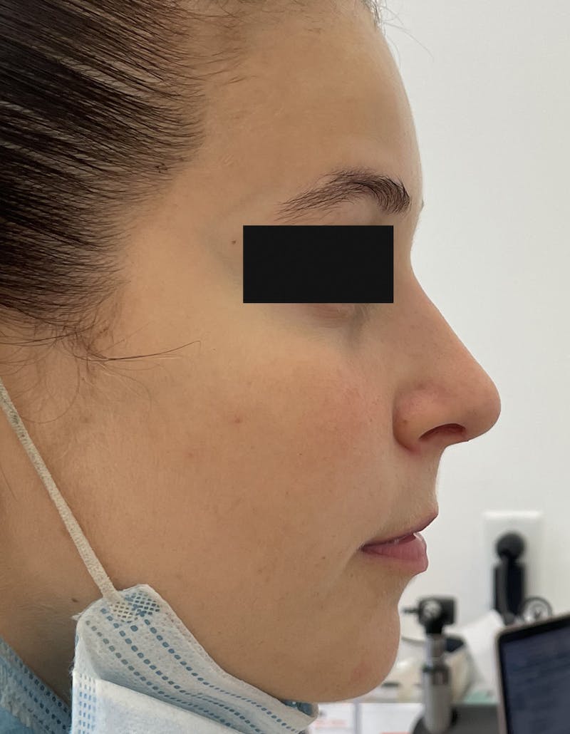 Rhinoplasty Before & After Gallery - Patient 93490328 - Image 2