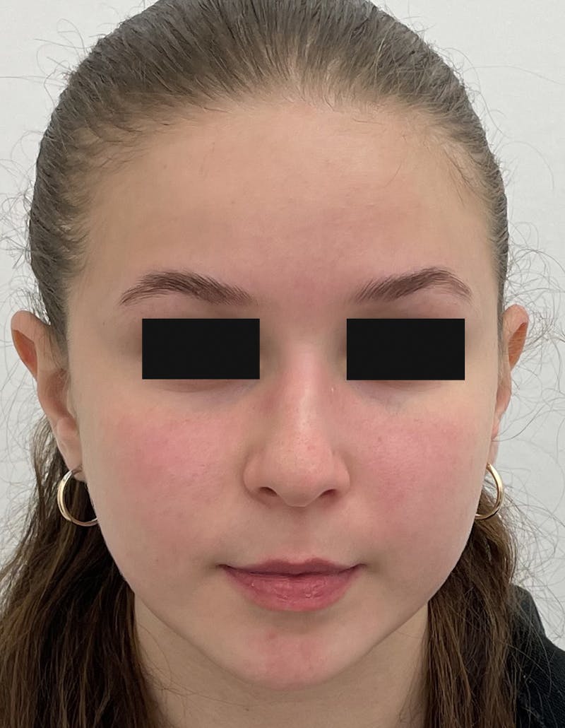 Rhinoplasty Before & After Gallery - Patient 93490328 - Image 3
