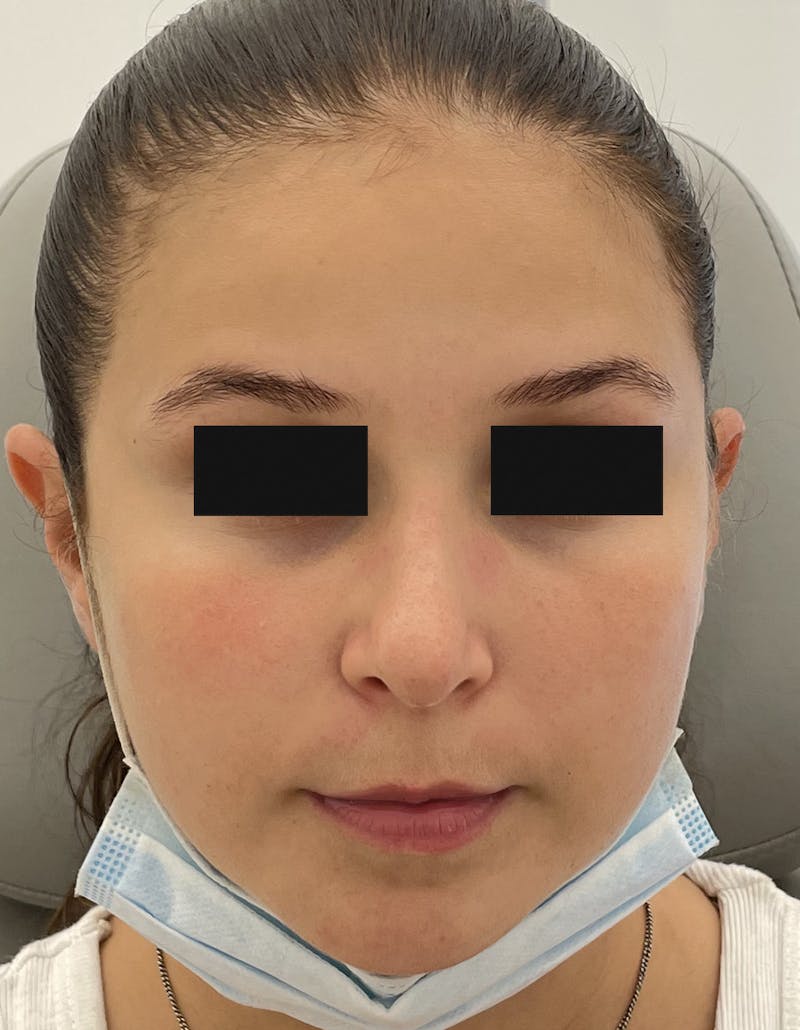 Rhinoplasty Before & After Gallery - Patient 93490328 - Image 4