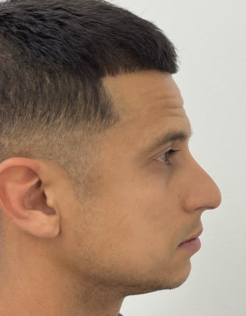 Rhinoplasty Before & After Gallery - Patient 91459326 - Image 3