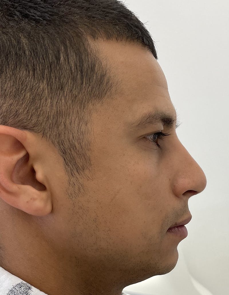 Rhinoplasty Before & After Gallery - Patient 91459326 - Image 4