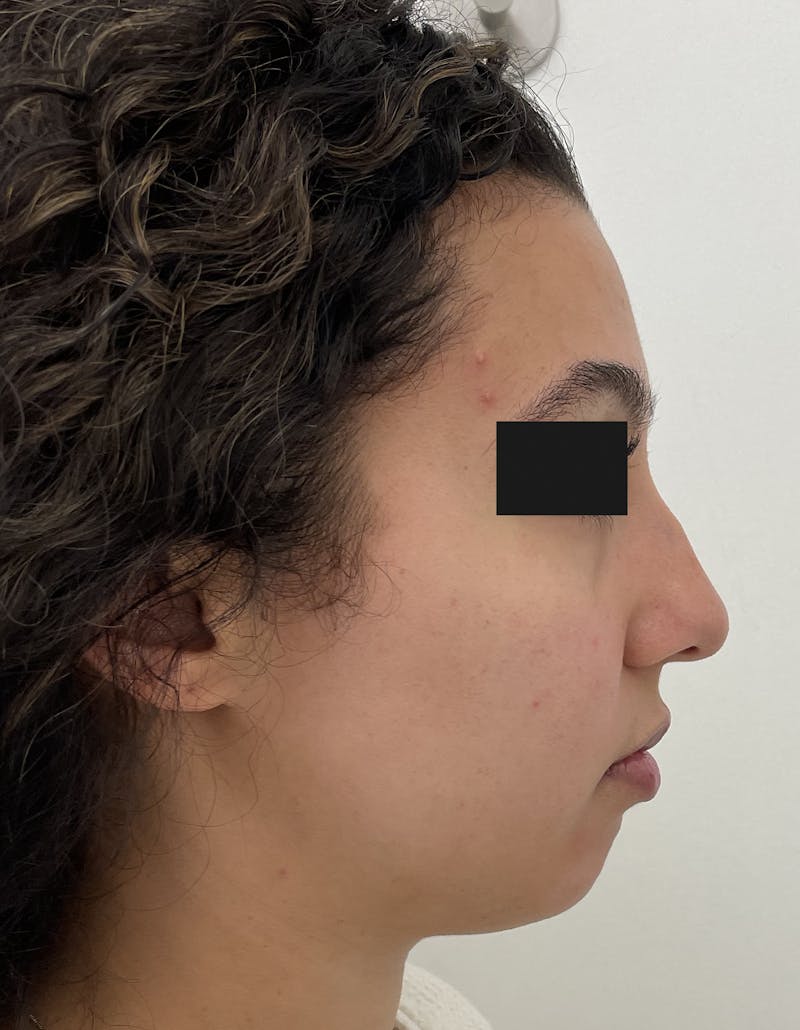 Before and after dermal fillers in Upper East Side