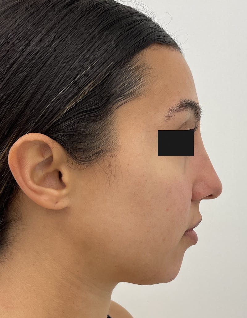 Before and after dermal fillers in Upper East Side