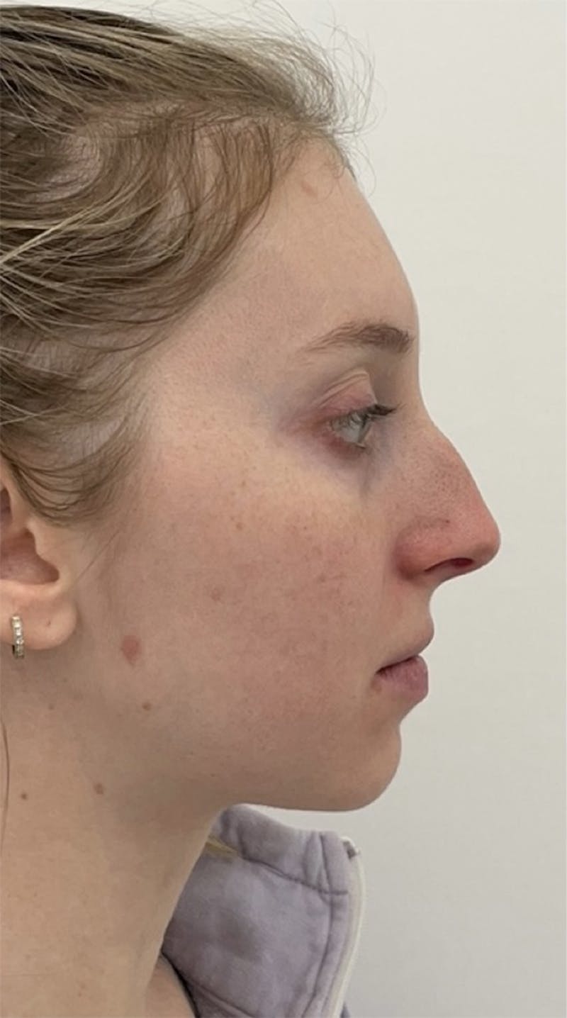 Before and after rhinoplasty in Upper East Side, patient 2