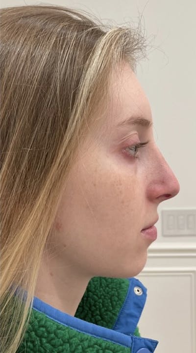 Rhinoplasty Before & After Gallery - Patient 120421151 - Image 2