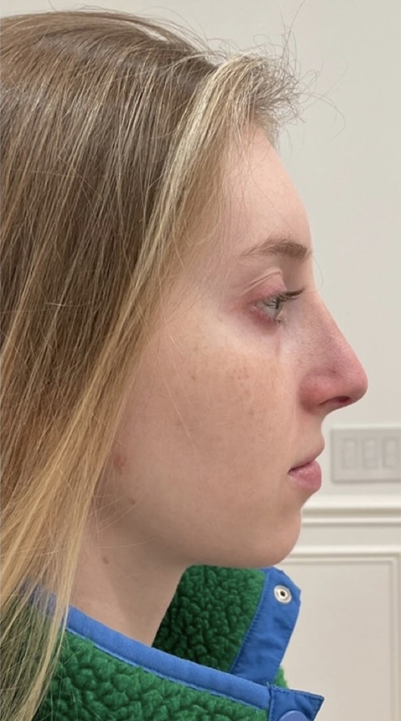 Before and after rhinoplasty in Upper East Side, patient 2