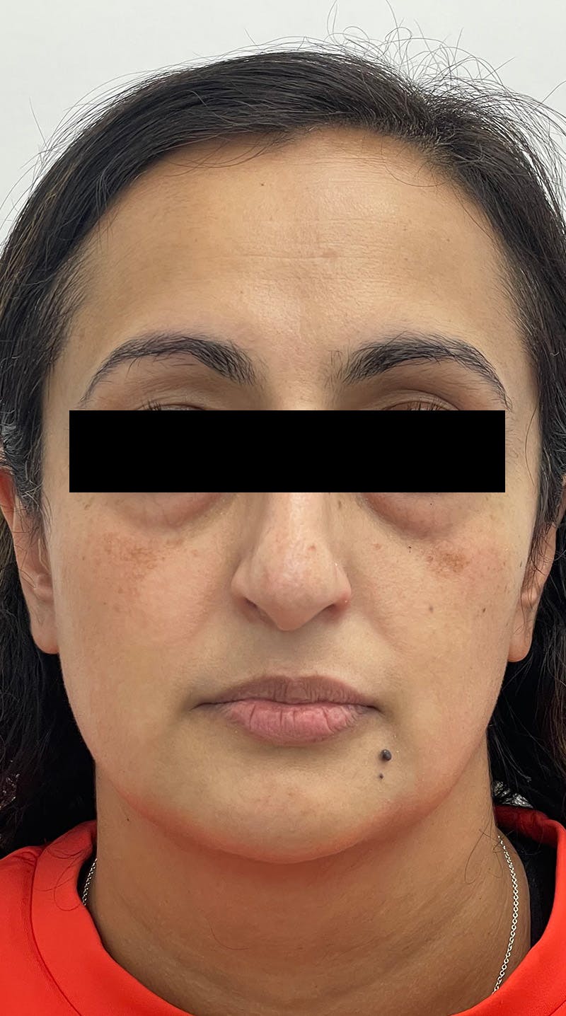 Blepharoplasty Before & After Gallery - Patient 122833325 - Image 1