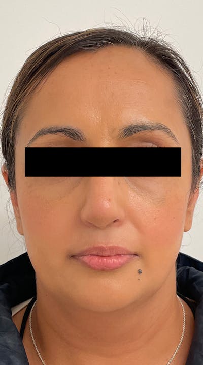 Blepharoplasty Before & After Gallery - Patient 122833325 - Image 2