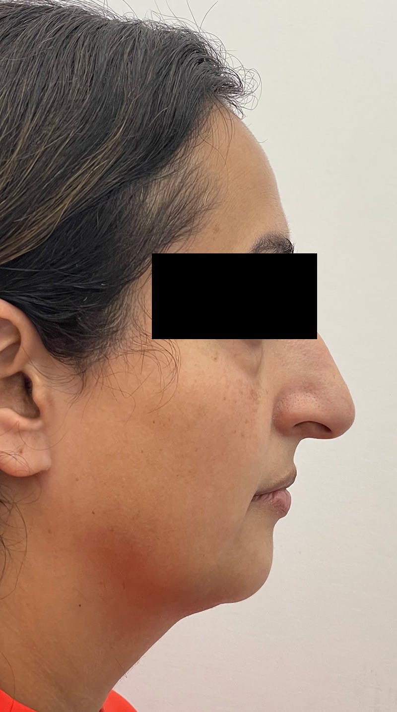 Rhinoplasty Before & After Gallery - Patient 122833309 - Image 3
