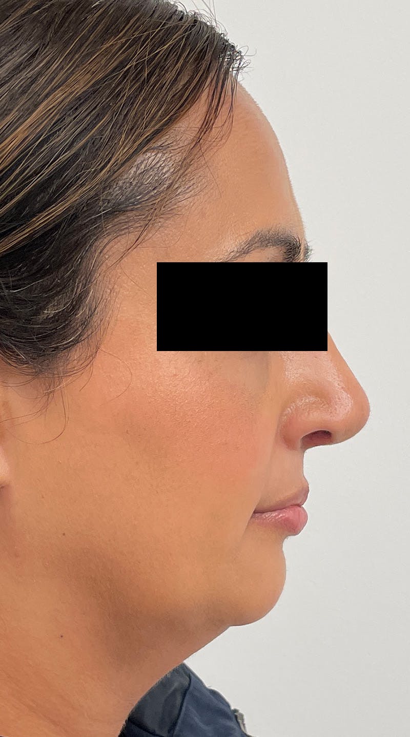 Blepharoplasty Before & After Gallery - Patient 122833325 - Image 4