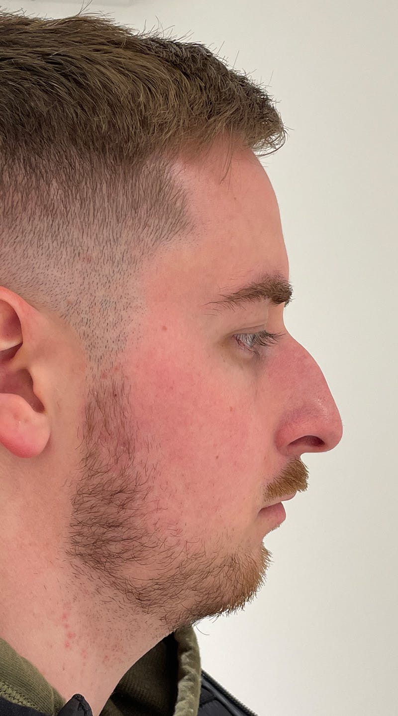 Rhinoplasty Before & After Gallery - Patient 122833307 - Image 1