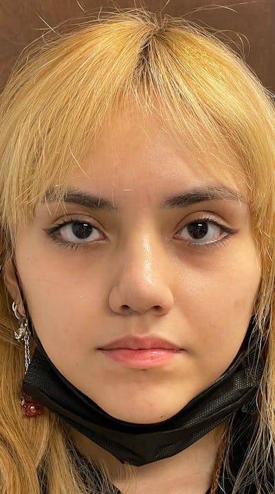 Rhinoplasty Before & After Gallery - Patient 122833308 - Image 2