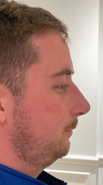 Rhinoplasty Before & After Gallery - Patient 122833307 - Image 2