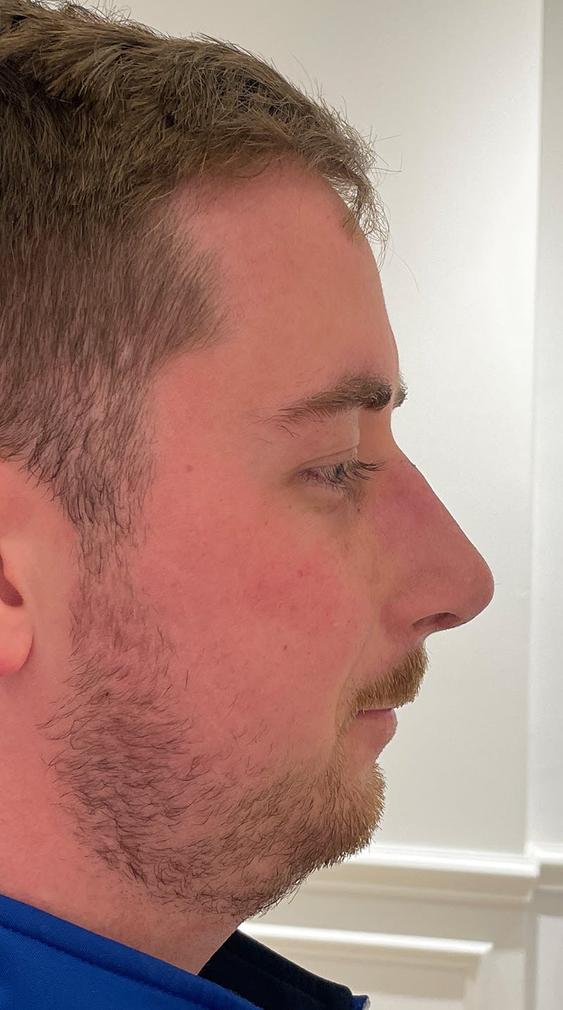 Before and after rhinoplasty in Upper East Side, patient 2