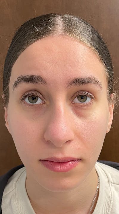Rhinoplasty Before & After Gallery - Patient 122833306 - Image 1