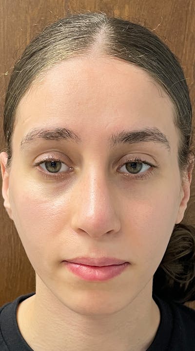 Rhinoplasty Before & After Gallery - Patient 122833306 - Image 2